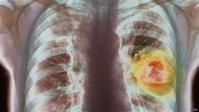 علماء بريطانيون يؤكدون فعالية جسيمات الذهب في علاج سرطان الرئة