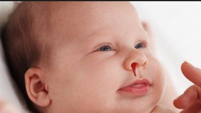 8 علامات تكشف إصابة طفلك بالنزيف الداخلي