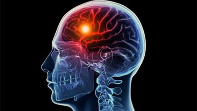270 ألف حالة جلطة بالمخ في مصر سنويًا