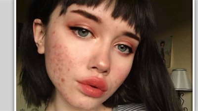 فتاة تواجه منتقدي حبوب وجهها (صور)