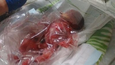 بالصور.. شاهد ماذا فعل الأطباء لإنقاذ رضيع ولد في بداية الشهر السادس