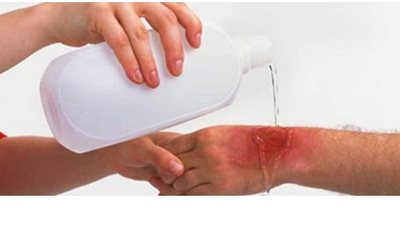 6 نصائح للتعامل مع الحروق البسيطة فى المنزل