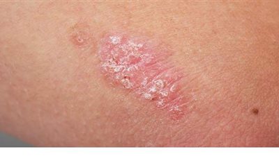 أعراض الإصابة بـ