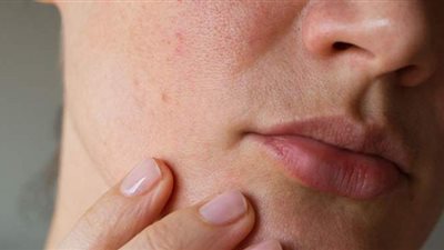 ١٠ أطعمة تسبب تهيج وحساسية للبشرة.. تعرف عليها