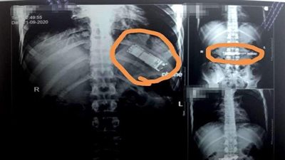 العثور على تليفون بمعدة شخص ابتلعه من 7 شهور بالقليوبية