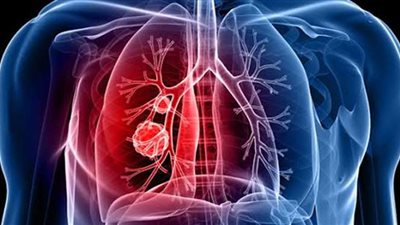 ٨ أعراض للإصابة بسرطان الرئة