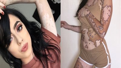 بالصور.. فتاة تتحدى البهاق بتحول جسدها لخريطة العالم