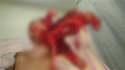 انفجار يد شاب أثناء لهوه بالألعاب الناريه في الدقهلية