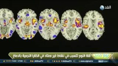 بالفيديو.. دراسة: النوم أقل من 7 ساعات يسبب تآكل المخ