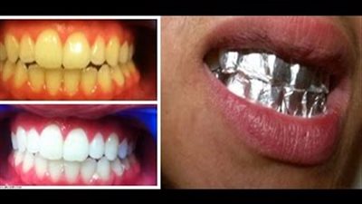 بالفيديو..وصفة مذهلة لتبييض الأسنان خلال ساعة