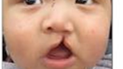 للأمهات.. الشفة الأرنبية تهدد صحة طفلك بـ4 أضرار