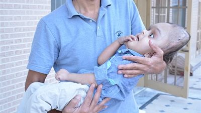 بالصور.. مكالمة مجهولة تنقذ حياة طفل متضخم الرأس