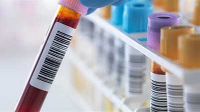 تحليل دم جديد قادر على الاكتشاف المبكر للأورام السرطانية