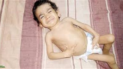 10 أسباب تؤدي إلى إصابة طفلك بضمور المخ