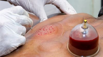 تعرفي على أنواع الحجامة وفوائدها للوقاية من الأمراض