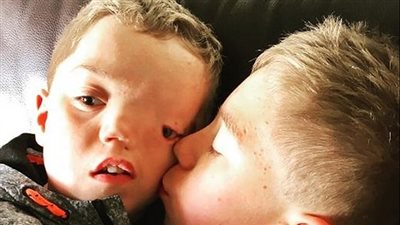 بالصور.. معاناة طفل بنصف وجه وصف بوحش الهالوين