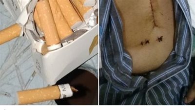 رد فعل صادم لمريض حاول تدخين سيجارة بعد عملية قلب مفتوح (صور)