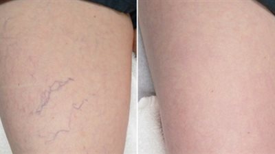 زيت بذور العنب يخلصك من دوالي الساقين