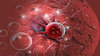 مدير سجل السرطان بمصر يكشف عن نسبة انتشاره بمصر