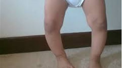 استشاري عظام يكشف أسباب إصابة الطفل بمرض الكساح