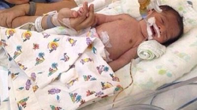 مستشفى كويتي ينقذ رضيعا مصريا من موت محقق على يد والدته