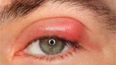 تعرفي على طرق علاج انتفاخ الجفون