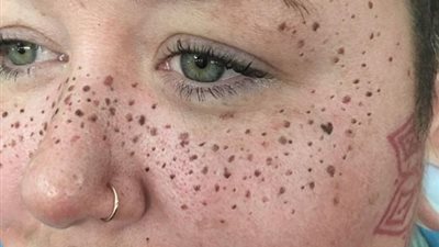 بالفيديو والصور.. وشم النمش أحدث صيحات الموضة