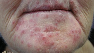 أسباب وأعراض حساسية الجلد التأتبي وطرق العلاج