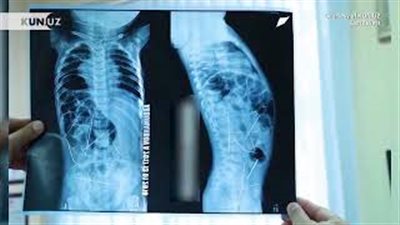 أطباء يعثرون على 16 إبرة خياطة بجسد طفل رضيع (فيديو)