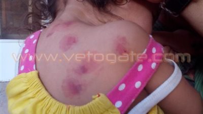 بالصور.. تعذيب طفلة داخل حضانة أطفال في سوهاج