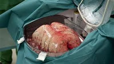 دراسة: إجراء عمليات نقل وزرع رئة للمدخنين آمنة وفعالة