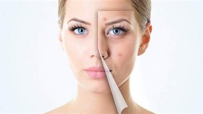 طرق بسيطة تساعدك على حماية بشرتك من الحبوب