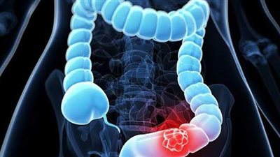 ٥ أسباب للإصابة بسرطان القولون.. احذرها