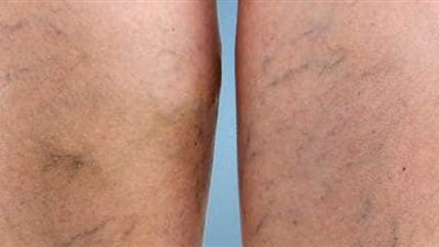 يجب علاجها بسرعة..  دوالي الساقين مشكلة تصيب الرجال والنساء