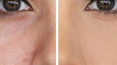 نصائح للعناية الطبيعية بالبشرة مفتوحة المسام