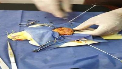 استئصال ورم بحجم كبير لطائر بكلية الطب البيطرى جامعة المنصورة | صور
