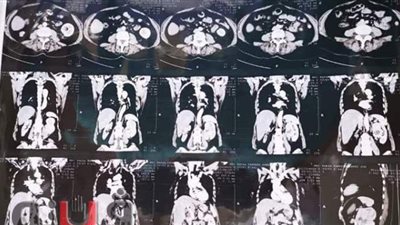 نجاح استئصال ورم سرطانى من كلى سيدة بمبرة المحلة في الغربية