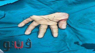 بترتها ماكينة مصنع.. فريق طبي بجامعة طنطا يعيد يد شاب مرة أخرى