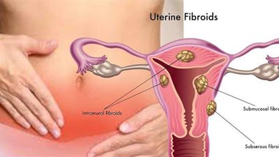 اكتشفي أعراض الإصابة بالأورام الليفية بالرحم.. وطرق العلاج