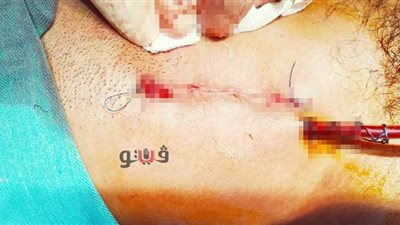 استخراج مسمار من رقبة شاب بمستشفى المنصورة العام الجديد