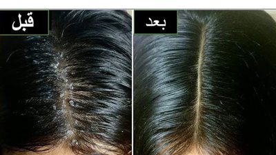 5 مواد طبيعية موجودة في مطبخك تخلصك نهائيا من قشرة الرأس