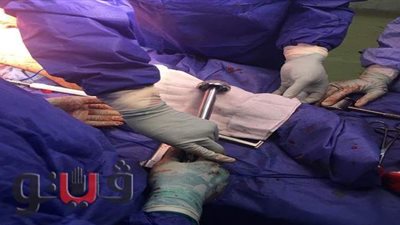 جراحة ناجحة لمريض من ذوي الهمم يعانى من كسر  بالفخذ بالشرقية