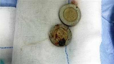 فريق طبي بمستشفى  قنا الجامعي يستخرج عملة 2 جنيه من مريء طفلة