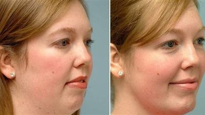 بدون عمليات.. 7 عادات حياتية تساعدك في التخلص من سمنة الوجه