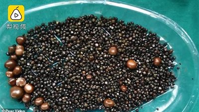 إزالة 2000 حصوة من مرارة مريضة بسبب تناول الدهون (صور)