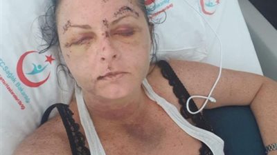 تشويه سائحة بريطانية رفضت علاقة مشبوهة في تركيا (صور)