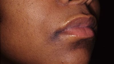 خبيرة تجميل تحدد 3 خطوات لعلاج اسمرار الذقن وحول الشفاة