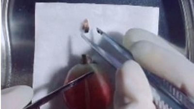 جراح يجرى عمليات للفاكهة كالحقيقية تماما (فيديو وصور)