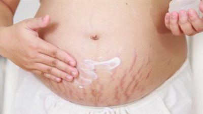 4 خطوات للتخلص من تشققات البطن