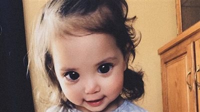 حالة وراثية نادرة تمنح طفلة عينين مميزتين (صور)